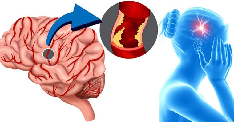 Consejo de un cardiólogo sobre el tratamiento y la prevención de la hipertensión